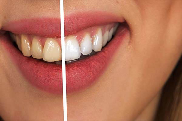 Evde Doğal Diş Beyazlatma Yöntemleri